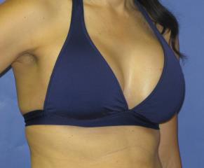 Breast Augmentation Before & After Patient #1267