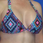 Breast Augmentation Before & After Patient #1272