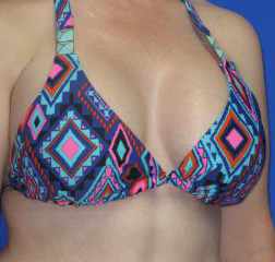 Breast Augmentation Before & After Patient #1272