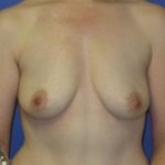 Breast Augmentation Before & After Patient #1275