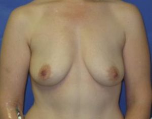 Breast Augmentation Before & After Patient #1275