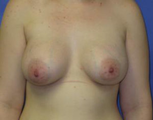 Breast Augmentation Before & After Patient #1275