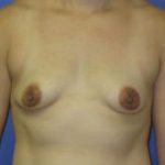 Breast Augmentation Before & After Patient #1278