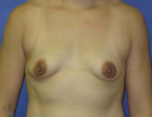 Breast Augmentation Before & After Patient #1278