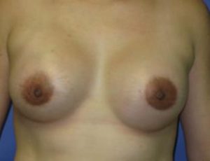 Breast Augmentation Before & After Patient #1278