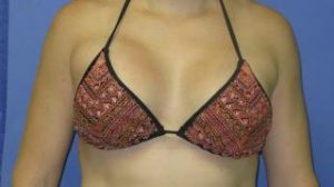 Breast Augmentation Before & After Patient #1285