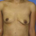 Breast Augmentation Before & After Patient #1288