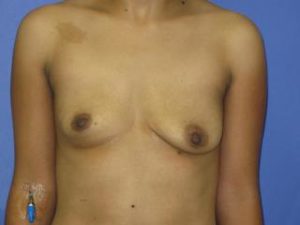 Breast Augmentation Before & After Patient #1288
