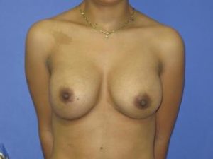 Breast Augmentation Before & After Patient #1288