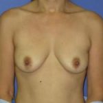 Breast Augmentation Before & After Patient #1294