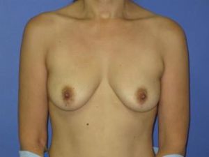 Breast Augmentation Before & After Patient #1294