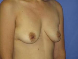 Breast Augmentation Before & After Patient #1294