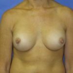 Breast Augmentation Before & After Patient #1299