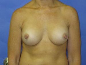 Breast Augmentation Before & After Patient #1299