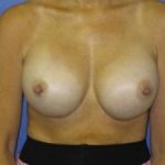 Breast Augmentation Before & After Patient #1299