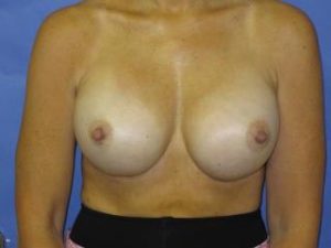 Breast Augmentation Before & After Patient #1299