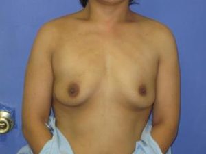 Breast Augmentation Before & After Patient #1306