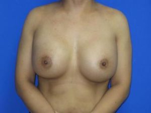 Breast Augmentation Before & After Patient #1306