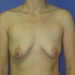 Breast Augmentation Before & After Patient #1310