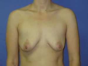 Breast Augmentation Before & After Patient #1310