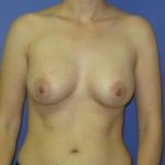 Breast Augmentation Before & After Patient #1310