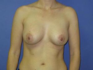 Breast Augmentation Before & After Patient #1310