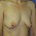 Breast Augmentation Before & After Patient #1310
