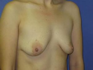 Breast Augmentation Before & After Patient #1310