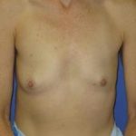 Breast Augmentation Before & After Patient #1316
