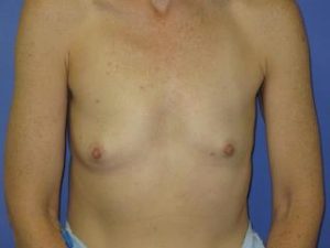 Breast Augmentation Before & After Patient #1316