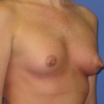 Breast Augmentation Before & After Patient #1320