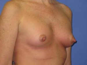 Breast Augmentation Before & After Patient #1320