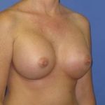 Breast Augmentation Before & After Patient #1320