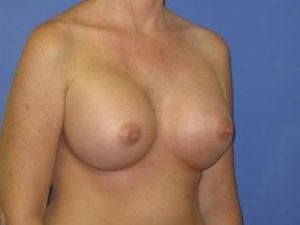 Breast Augmentation Before & After Patient #1320