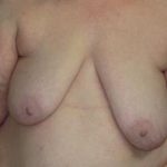 Breast Lift Before & After Patient #7351