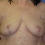 Breast Lift Before & After Patient #7351