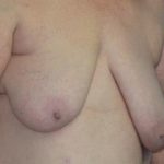 Breast Lift Before & After Patient #7351