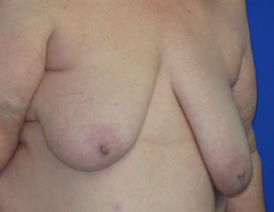 Breast Lift Before & After Patient #7351