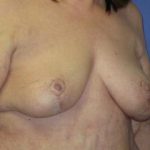 Breast Lift Before & After Patient #7351
