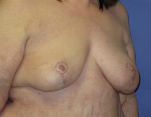 Breast Lift Before & After Patient #7351