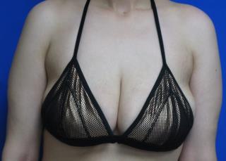 Breast Lift Before & After Patient #7361