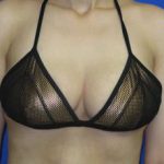 Breast Lift Before & After Patient #7361