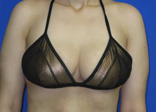 Breast Lift Before & After Patient #7361