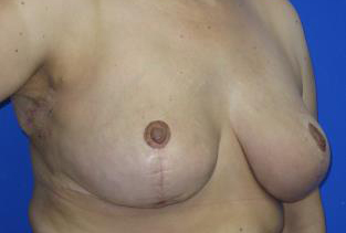 Breast Lift Before & After Patient #7364