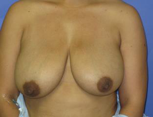 Breast Lift Before & After Patient #7369