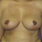 Breast Lift Before & After Patient #7369