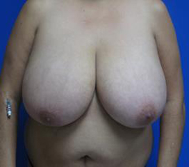 Breast Lift Before & After Patient #7374