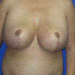 Breast Lift Before & After Patient #7374