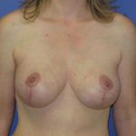 Breast Lift Before & After Patient #7384