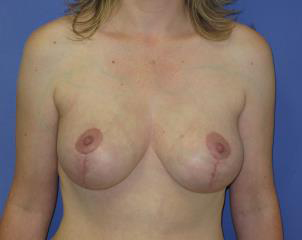 Breast Lift Before & After Patient #7384
